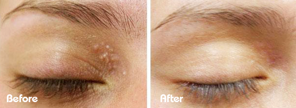 Milia removal before and after cryotherapy treatment